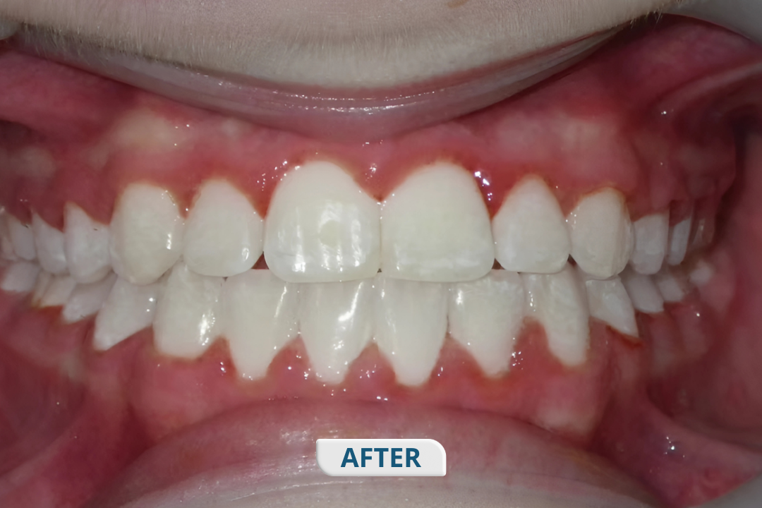 After treatment at Namira Oro Dental Care